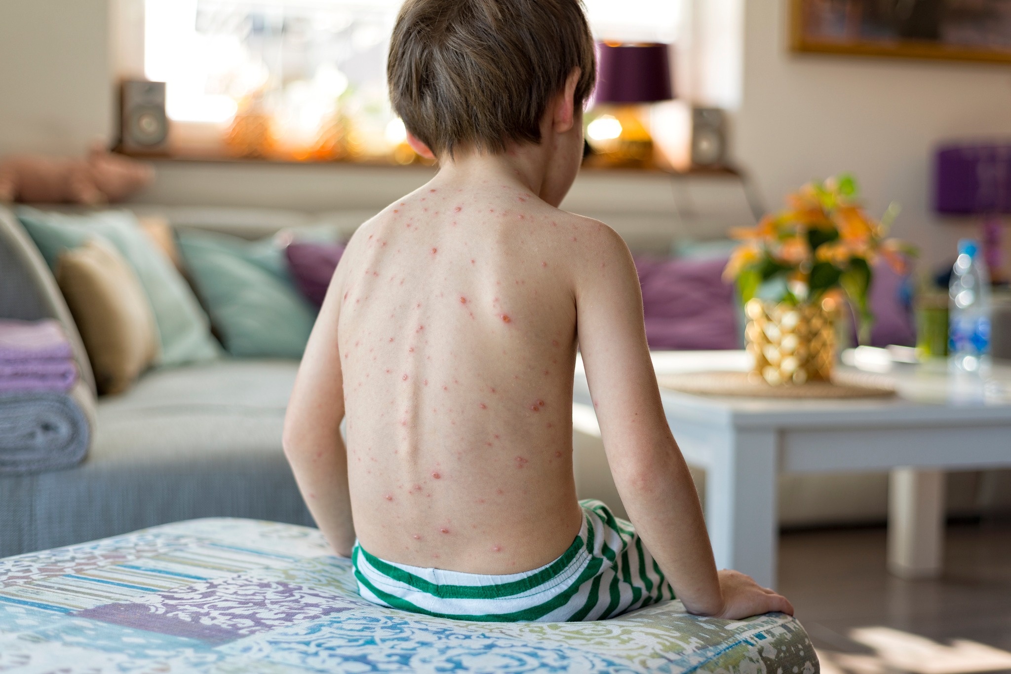 Регистрирани са 18 случая на морбили в страната